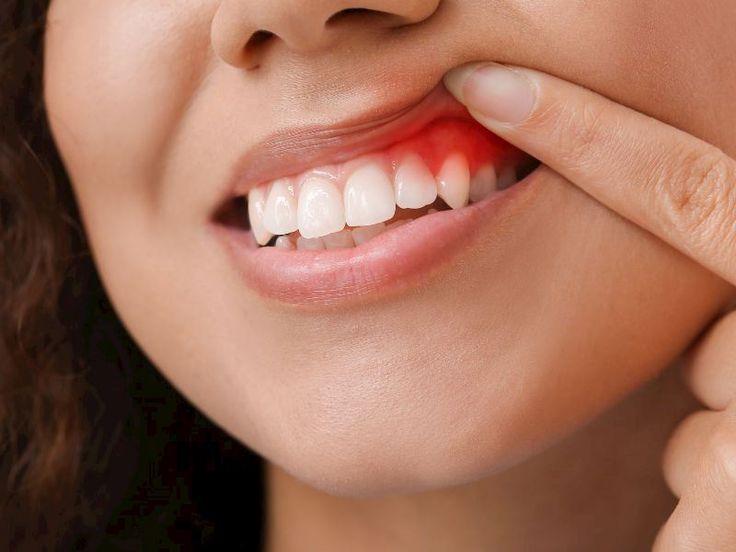 Periodontal Hastalıkların Belirtileri