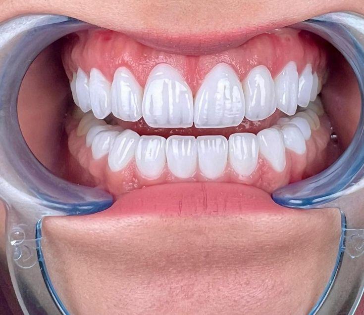 Diş Restorasyonunun Amacı Nedir?
